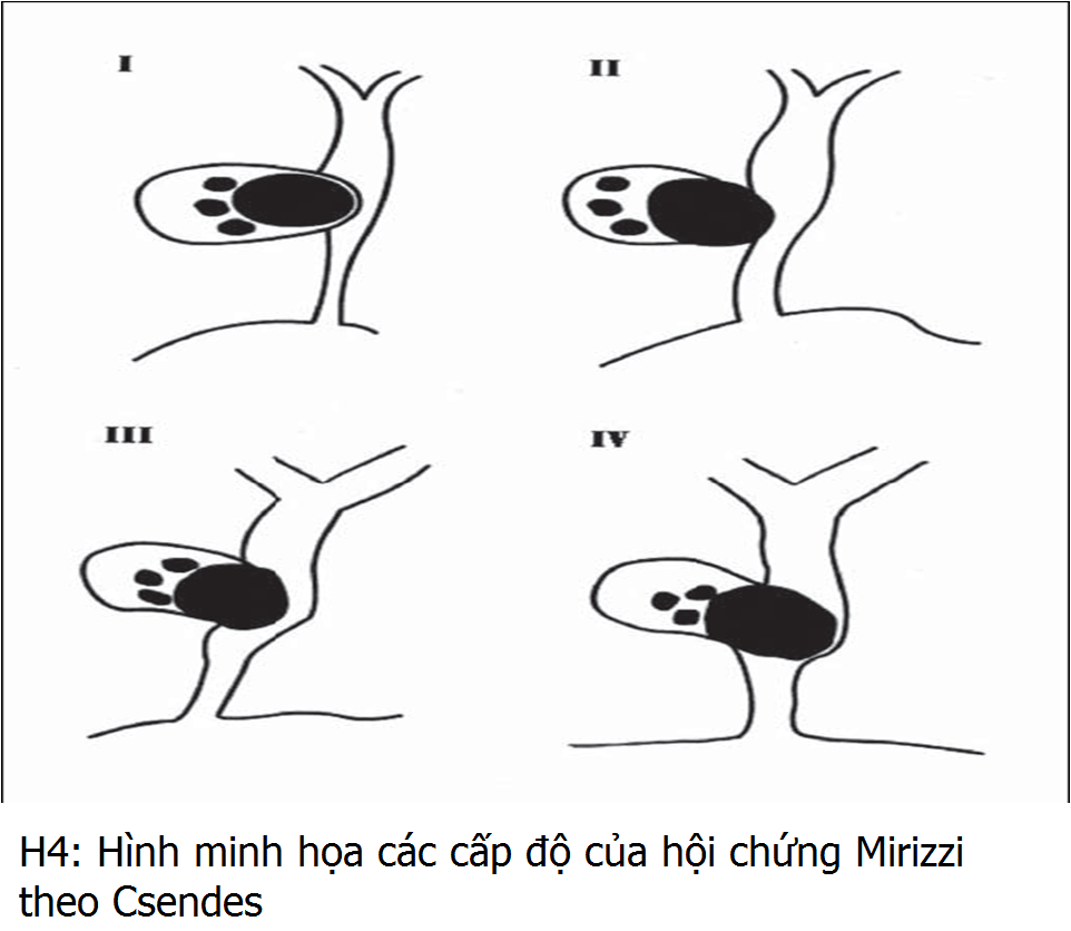 Hội chứng Mirizzi - Hình ảnh minh họa